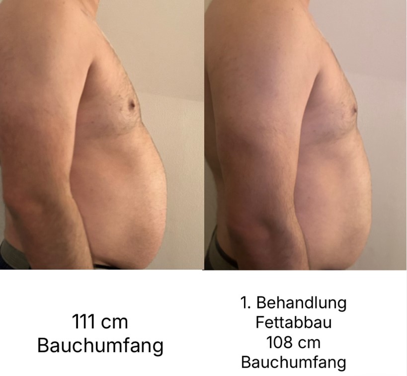 Bodyforming / Bodysculpting (EMS)